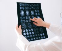 Imagen conceptual de investigación médica sobre tumores cerebrales en un hospital español