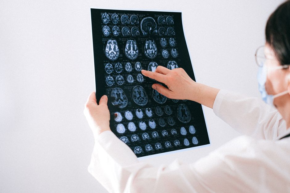 Imagen conceptual de investigación médica sobre tumores cerebrales en un hospital español